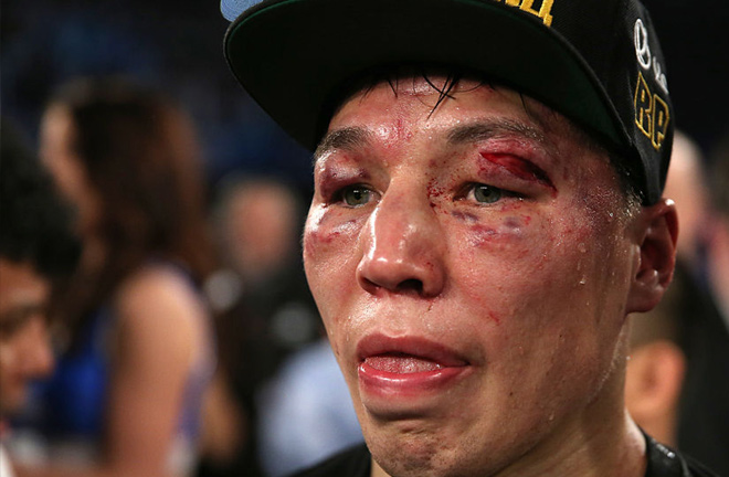 Provodnikov wearing his war wounds of his battle against John Molina. Photo Credit: Sky Sports